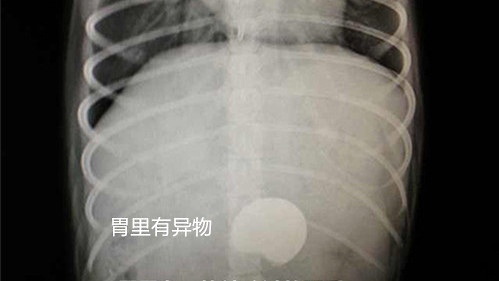 X光片可見胃內異物