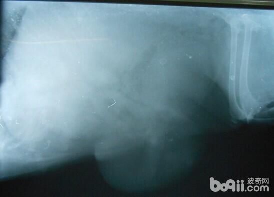   X光下腹部腫瘤