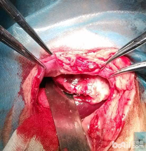  經檢查後，麻醉備皮後，由刀口位置切開皮膚探查刀刺入位置，看到刀深入胃部，胃部有切口。