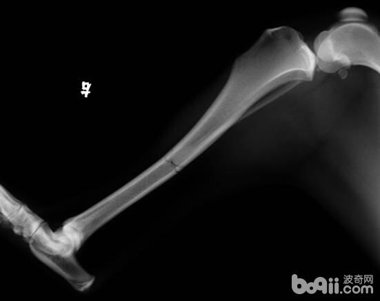 X光側位顯示胫骨骨干骨折