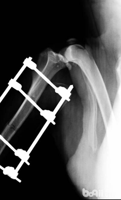  骨折後外固定支架在X光下圖片。
