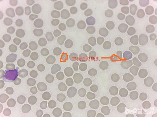 血塗片可見帶有蟲體的紅細胞