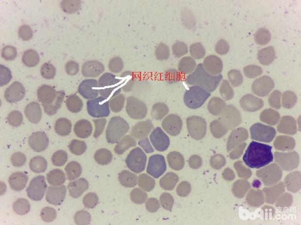 血塗片中可見大量的網織紅細胞