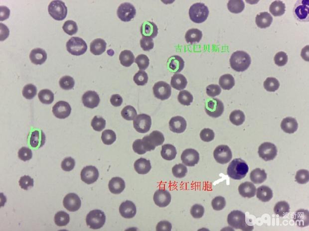 有核紅細胞及大量帶有蟲體的紅細胞