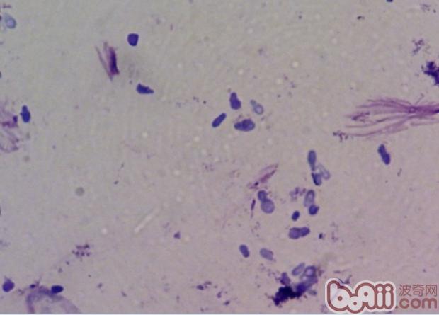 圖2 左耳分泌物染色後可見少量馬拉色菌