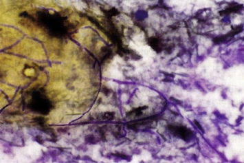 圖4：鼻部組織的細胞學圖片可見煙曲霉菌絲