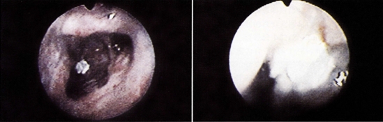 圖3：患鼻曲霉菌病的犬的外鼻孔進行鼻鏡檢查，可以看到鼻甲的缺失以及棕紅色的肉芽腫和白色的真菌斑塊