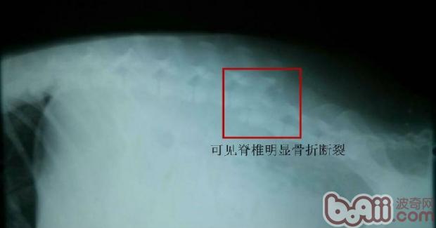 圖2  X光片顯示，骨折斷裂明顯