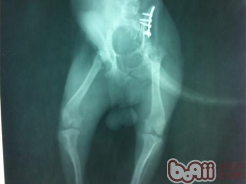  復位後的X光片，腹背位，可見明顯植入的骨板