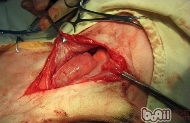 手術過程中腹部的切口位置