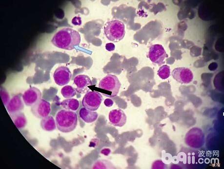 患有傳染性性病腫瘤的犬的陰道細胞學檢查，傳染性性病腫瘤細胞呈圓形或者橢圓形，富含藍色胞漿，細胞核多是位於細胞的一側，細胞核突出（如圖藍色箭頭所示），細胞質內可見數量不等的透明空泡（圖中黑色箭頭所示）。