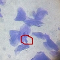 這是一張顯微鏡下的馬拉色菌圖片，是囡囡在做皮膚病膠帶法鏡檢時拍攝的，某個視野下的單個馬拉色菌：圓圈中花生樣的及時馬拉色菌，其他有透明感且的不規則的都是角質細胞。