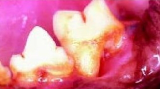嚴重牙周炎（貓的反復性口炎常見的表現），牙周組織嚴重損傷，牙根暴露