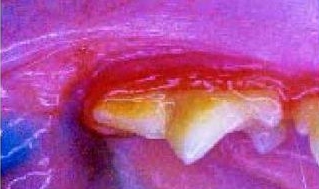 較嚴重的牙周炎（很多貓的反復性口炎，早期的表現），牙龈紅腫，明顯的牙結石，口腔粘膜輕度潰瘍
