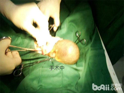 隱睾手術