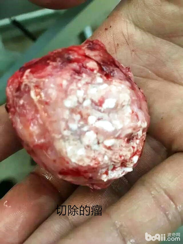 切除的骨肉瘤