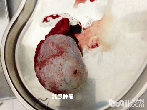 切除的乳腺腫瘤