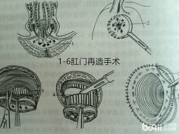 肛門再造手術