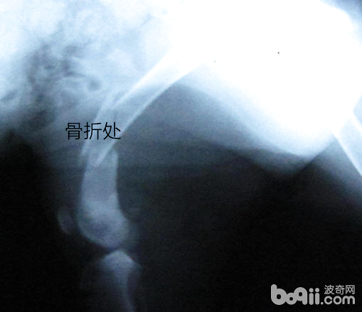X光片見骨折處