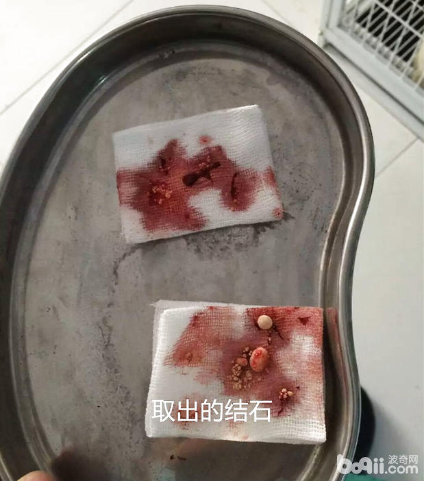 取出的結石