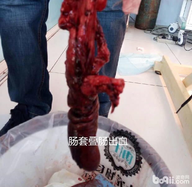 腸套疊