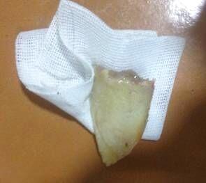 取出來的異物，骨頭