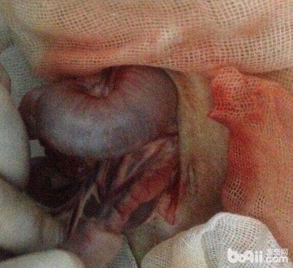 將套疊部分輕松緩慢移出腹腔，用創巾隔離，兩個手輕輕握住套疊後端，並向前輕輕將被嵌入腸管擠出。