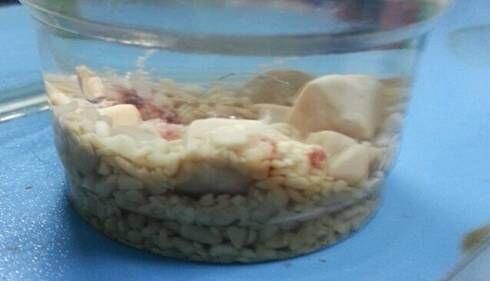從膀胱內取出的結石