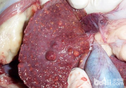 肝疾病引發腹水