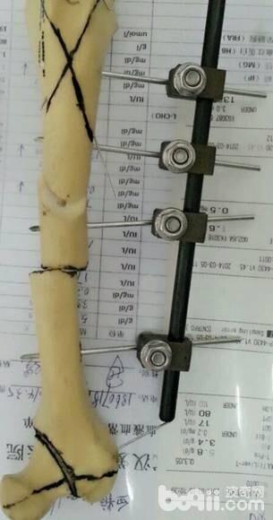 外固定支架