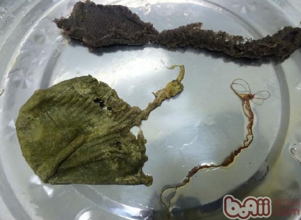 圖5 腸管內取出的異物，絲線將腸管纏繞到一起