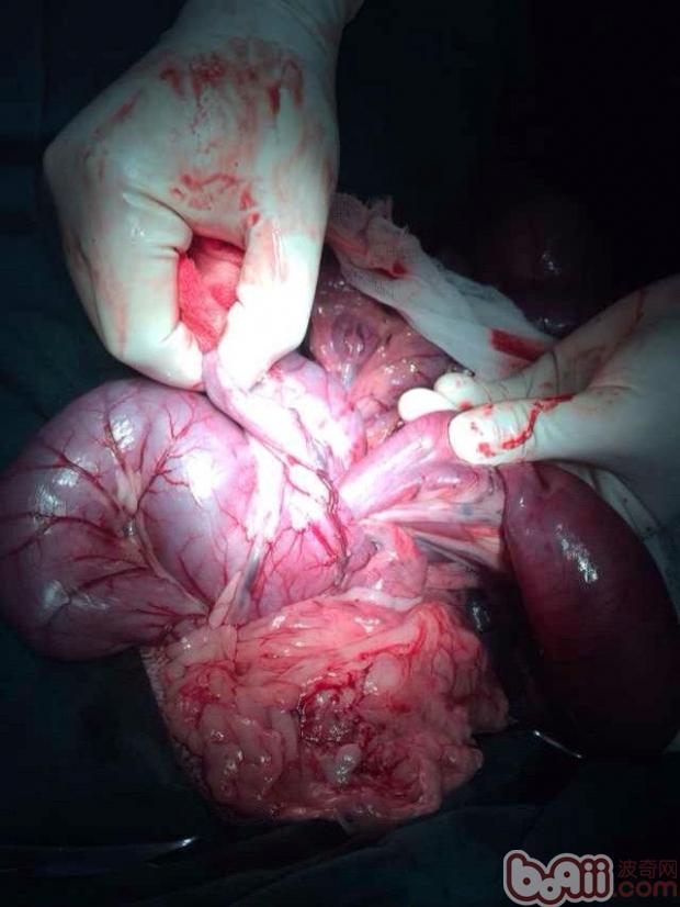 套疊處已經出現壞死，腸管淤青，需進行腸管端端吻合術，切掉可能壞死的腸管。