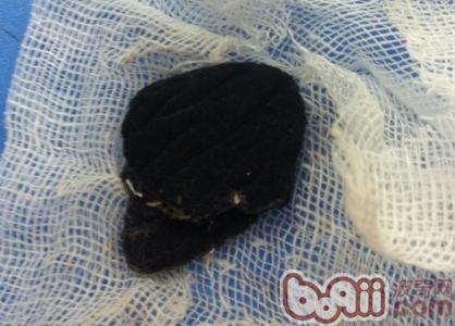 腸內取出的膠皮