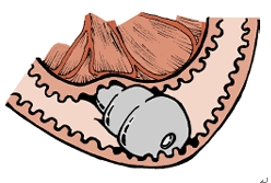 上圖為腸道內阻塞異物