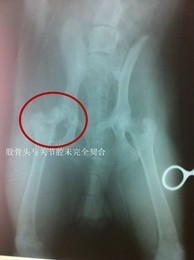 先天性股關節發育不良