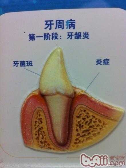 牙菌斑帶來的危害