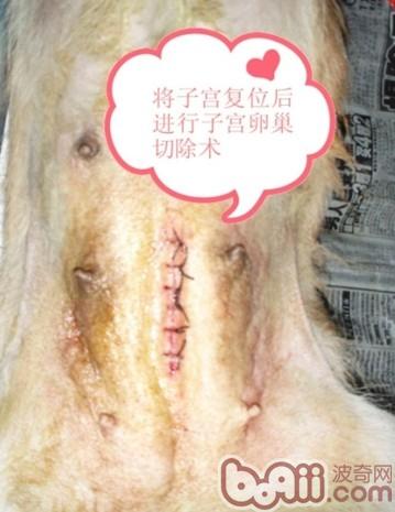 子宮復位後進行子宮卵巢切除手術