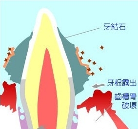 牙周組織破損示意圖