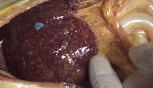 腹腔內滲出液在肝髒表面形成一層纖維素
