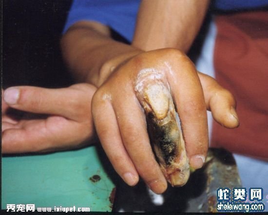 被毒蛇傷常見並發症及後遺症的處理方法